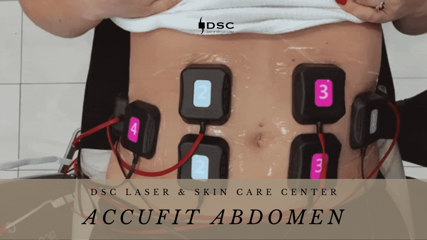 DSC Accufit treatment to the anterior abdomen showing gif of Accufit contacts attached to abdomen