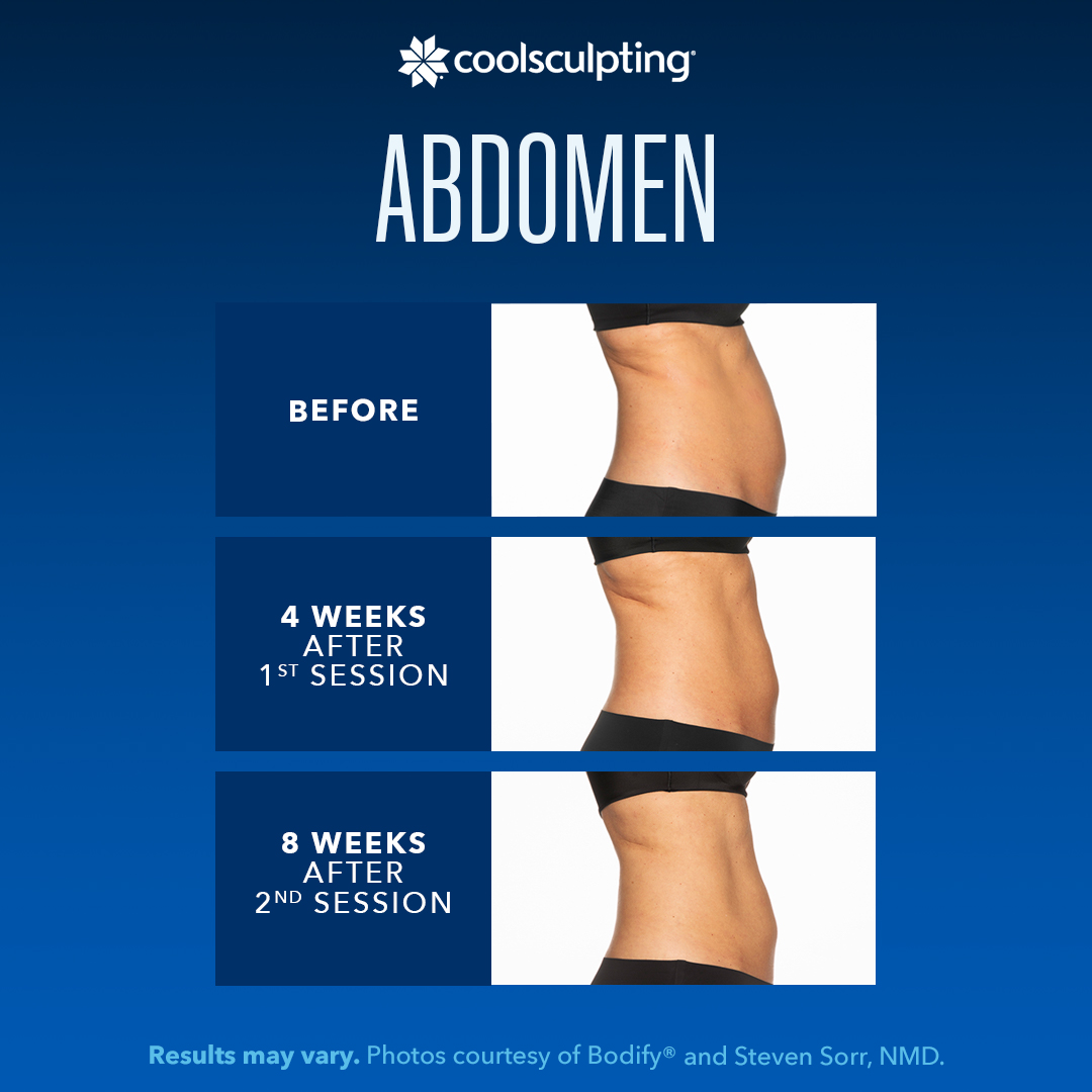 Coolsculpting Before During and After photos of Abdomen and Flanks witth Before photo of abdomen in profile at top, 4 weeks after 1st session picture in the middle, and 8 weeks after 2nd session at the bottom