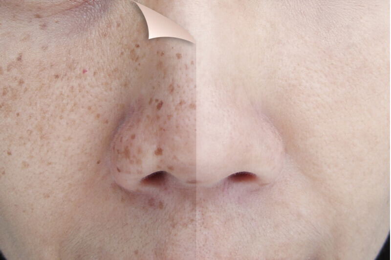 3 Major Things To Know About The Pico Laser Treatment Process