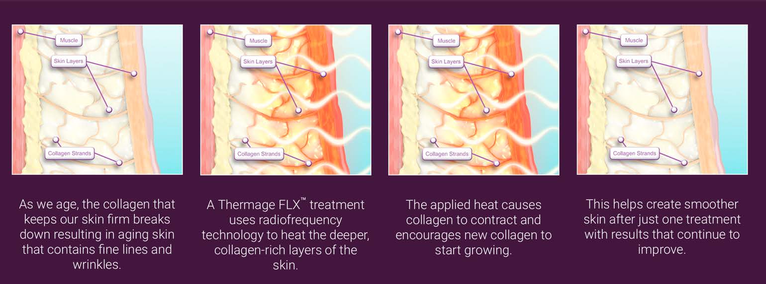 Thermage