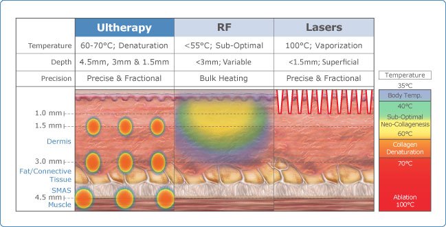 Ultherapy