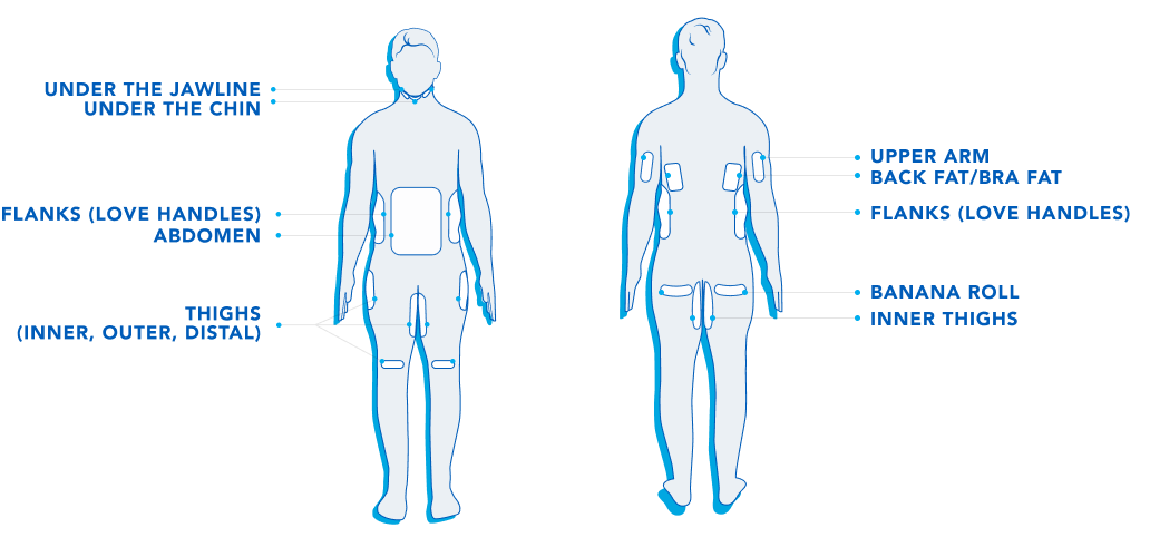 Male silhouette with possible Coolsculpting treatment areas delineated - chin, anterior abdomen, flanks, knees, banana roll (under the glutes), arms, back/bra bulge, and thighs